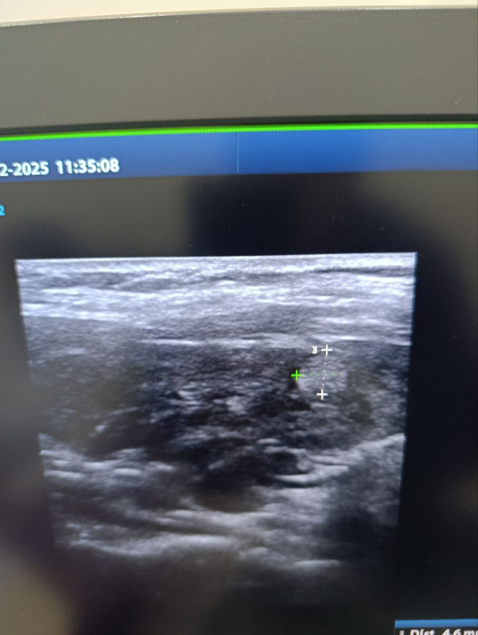 Ultrasound