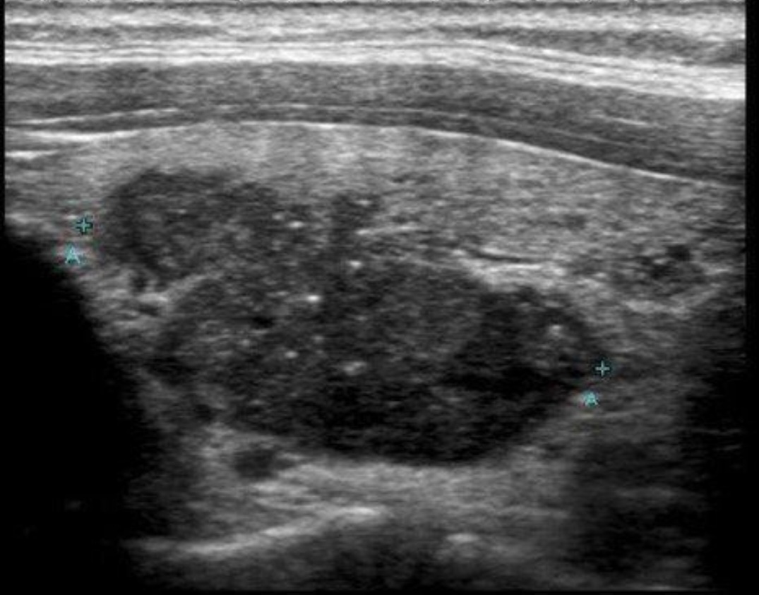 Ultrasound