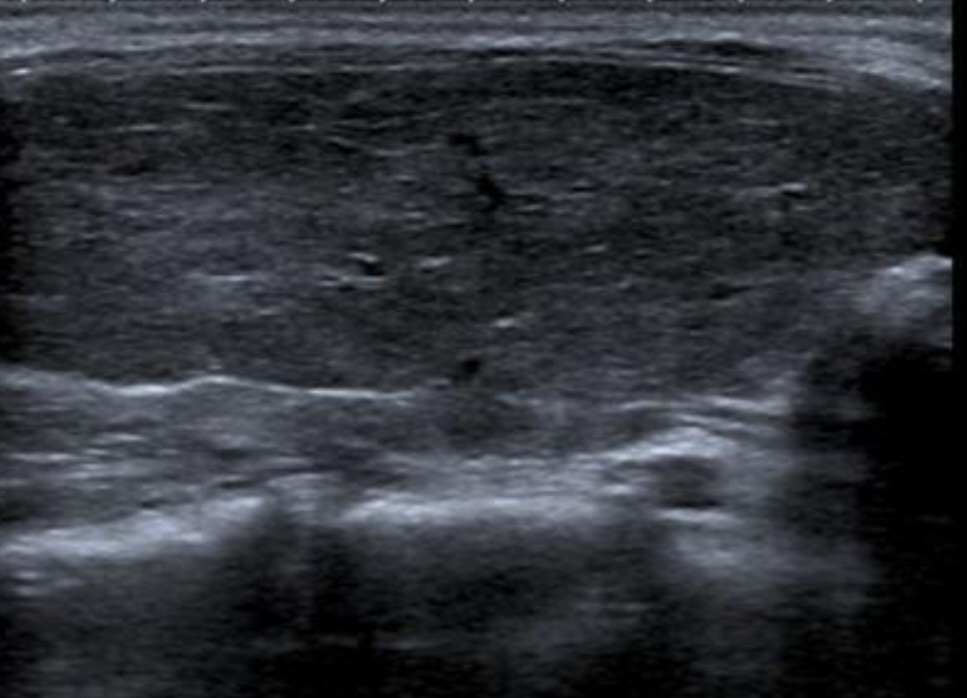 Ultrasound