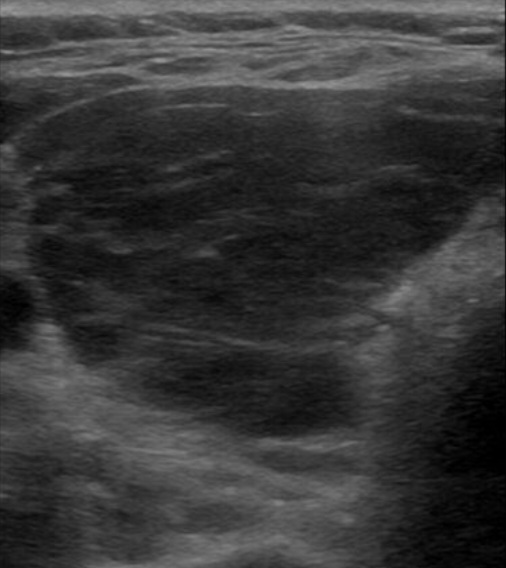 Ultrasound