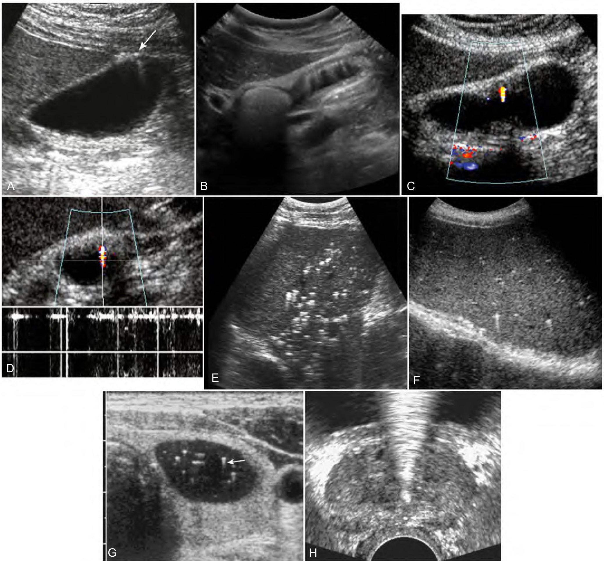 Ultrasound